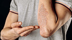 https://www.freepik.com/premium-photo/acute-psoriasis-elbows-is-autoimmune-incurable-dermatological-skin-disease-large-red-inflamed-flaky-rash-elbows-joints-affected-by-psoriatic-arthritis_35679002.htm
